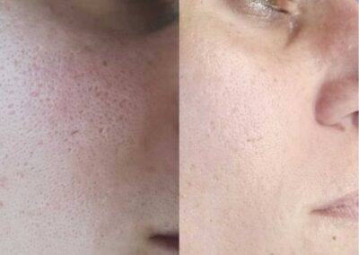 Risultato prima e dopo trattamento microneedling viso eseguito da Giorgia Arzenton