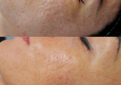 Prima e dopo microneedling viso per miglioramento della grana della pelle presso Aurea Studio