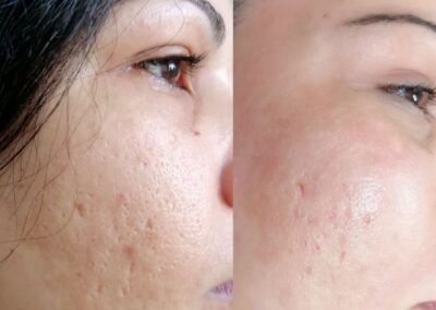 Prima e dopo microneedling viso per riduzione delle imperfezioni cutanee presso Aurea Studio