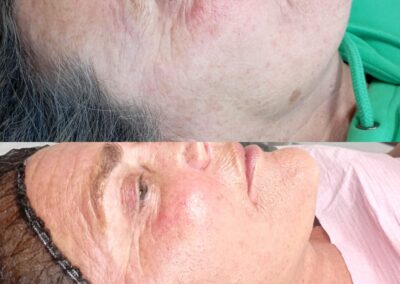 Prima e dopo microneedling viso su pelle matura presso Aurea Studio