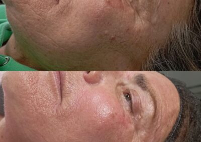 Prima e dopo microneedling viso per miglioramento di rughe e luminosità su pelle matura presso Aurea Studio