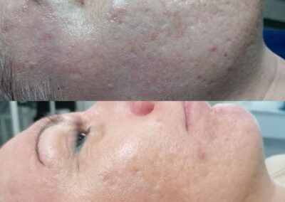 Prima e dopo trattamento microneedling viso per miglioramento della texture cutanea presso Aurea Studio