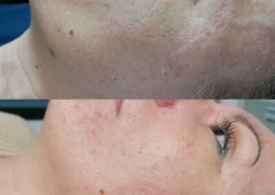 Prima e dopo microneedling viso per uniformità e luminosità della pelle presso Aurea Studio