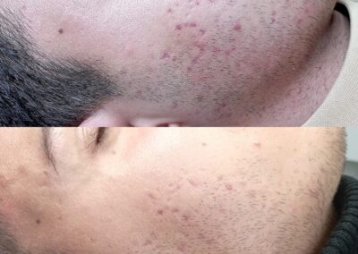 Prima e dopo microneedling viso uomo con acne e imperfezioni nella zona barba presso Aurea Studio