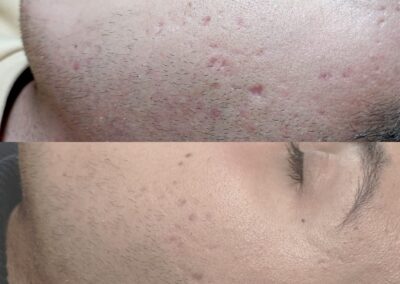 Prima e dopo microneedling viso uomo per miglioramento delle imperfezioni cutanee presso Aurea Studio
