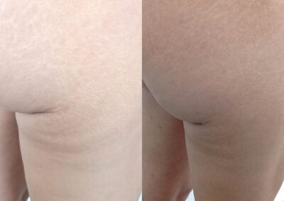 Prima e dopo trattamento smagliature corpo con microneedling per migliorare la texture della pelle