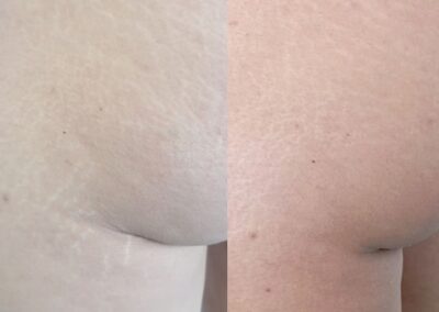 Prima e dopo trattamento smagliature con microneedling per migliorare la texture della pelle presso Aurea Studio